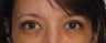 Upper Blepharoplasty