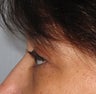 Upper Blepharoplasty