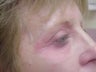 Eyelid surgery with CO2 laser resurfacing