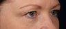Eyelid surgery