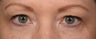 Eyelid surgery