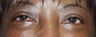 Eyelid surgery