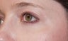 Eyelid surgery