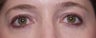 Eyelid surgery