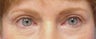 Eyelid surgery