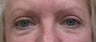 Eyelid surgery