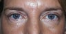 Upper Lid Blepharoplasty