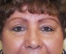 Upper Lid Blepharoplasty and Ptosis Repair