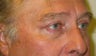 Upper Lid Blepharoplasty