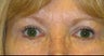 Upper and Lower Lid Blepharoplasty