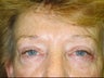 Upper and Lower Lid Blepharoplasty