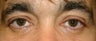 Eyelift