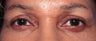 Eyelid Lift Surgery