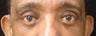 Upper Blepharoplasty