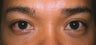 Asian Eyelid Surgery