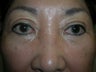 Blepharoplasty