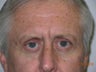 Blepharoplasty