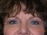 Blepharoplasty