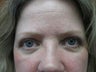 Blepharoplasty