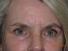 Blepharoplasty