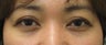 Eyelid retraction repair in thyroid disease by CO2 laser