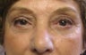 Upper eyelid ptosis repair and lower eyelid blepharoplasty and midface lift