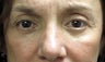 Upper and lower bleph and midface/cheek lift