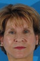 Upper eyelid lift