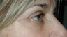 Upper Blepharoplasty, IPL
