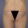 Butt Augmentation