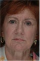 Upper and Lower Blepharoplasty or Eyelid Lift, Eye Bags treatment