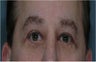 Eyelid Lift, Blepharoplasty, Eye Bags Treatment
