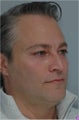 Blepharoplasty, Eyelid Lift, Chemical Peel, Fat Injections