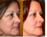 Upper and Lower Blepharoplasty (eyelid lift)