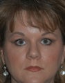 Eyelid Surgery