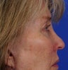 Blepharoplasty