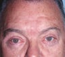 Blepharoplasty