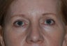 Blepharoplasty