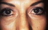 Blepharoplasty