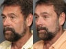 Endoscopic Forehead/Midface Lift, Upper and Lower Eyelids