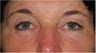 upper and lower Laser Blepharoplasty-Eyelid Surgery