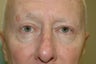 Bilateral upper blepharoplasty