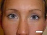 Eyelid Surgery (Blepharoplasty)