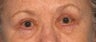 Upper and Lower Lid Blepharoplasty