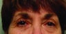 Ptosis Repair
