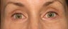 Upper and Lower Lid Blepharoplasty