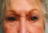Four lid Blepharoplasty