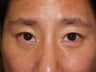 Lower Lid Blepharoplasty