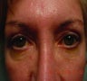 Ptosis Repair
