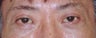 Upper and Lower Blepharoplasty